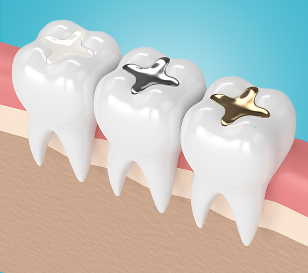 Linden Composite Fillings