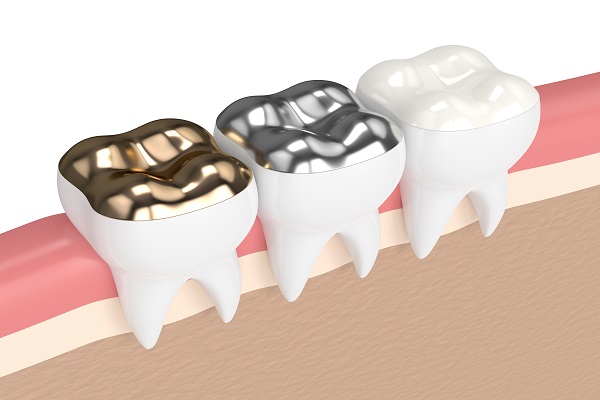 How Long Do Dental Fillings Last?