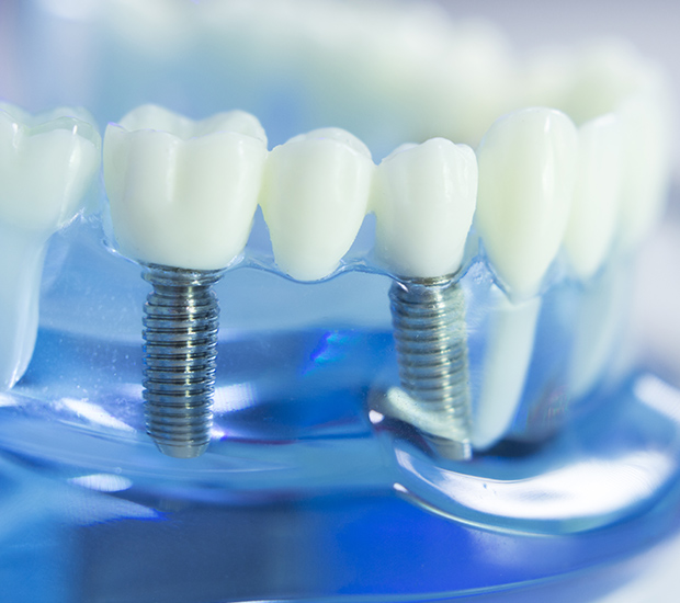 Linden Dental Implants